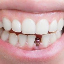 metal part of implant between teeth