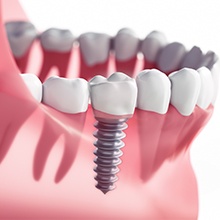 illustration of implant in jaw