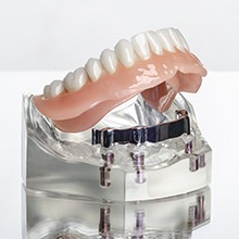 mockup of implant denture