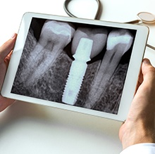 implant on x-ray